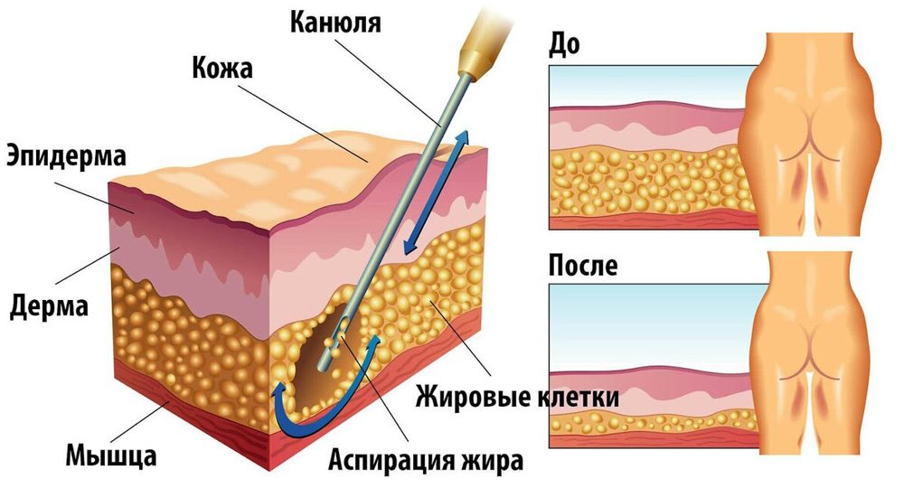 Коррекция фигуры